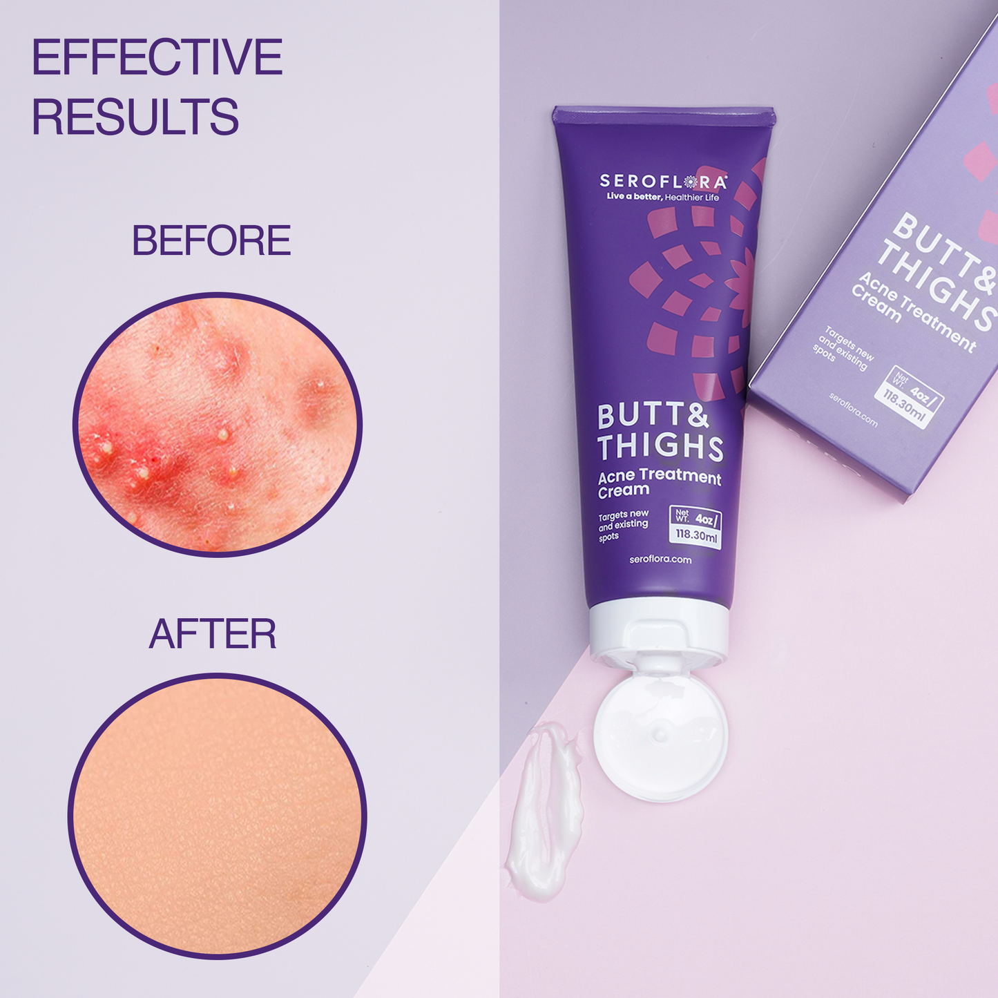 Butt & Thighs Acne Treatment Cream